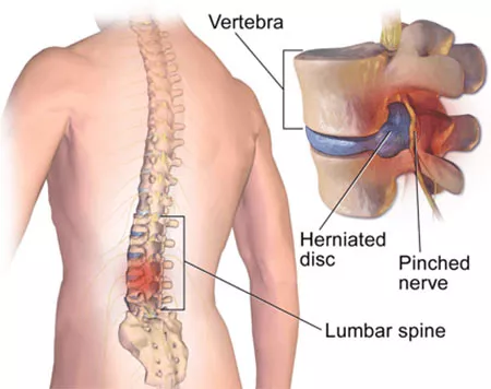 Back Pinched Nerve Treatment Doctor NYC· Sports Injury Clinic