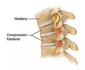 back pain compression fracture treatment