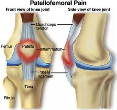 pain under kneecap