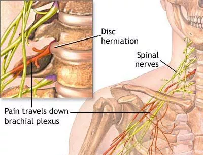 Pinched Nerve in Neck or Back