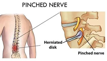 Treatment for Pinched Nerves (Neck)