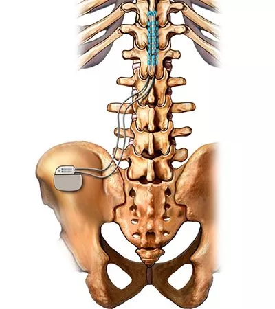 spinal chord stimulator