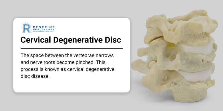 Cervical Degenerative Disc - NJ's Top Orthopedic Spine & Pain ...
