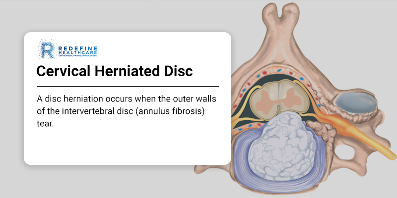 Professional Orthopaedic Associates - A herniated disc is the