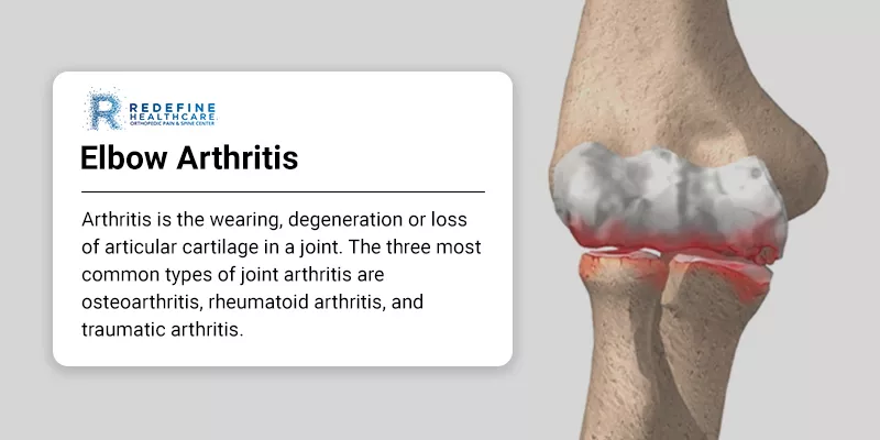 Elbow Arthritis - NJ's Top Orthopedic Spine & Pain Management Center