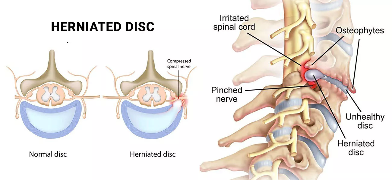 Herniated Disc (Ruptured or Slipped Spinal Disc)