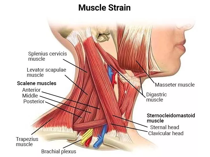 What are the symptoms of a stiff neck? Does a stiff neck always