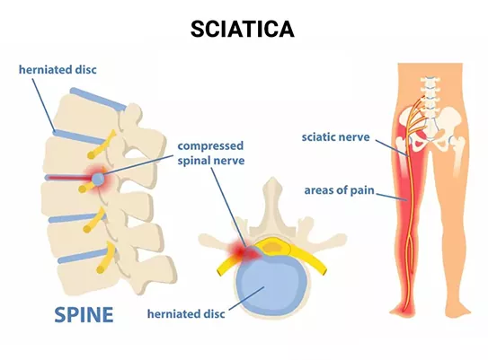 Sciatica: What It Is, Causes, Symptoms, Treatment & Pain Relief