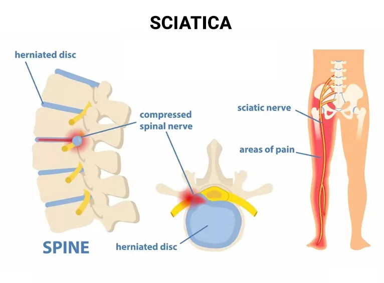 Lower Back Pain: What Could It Be?