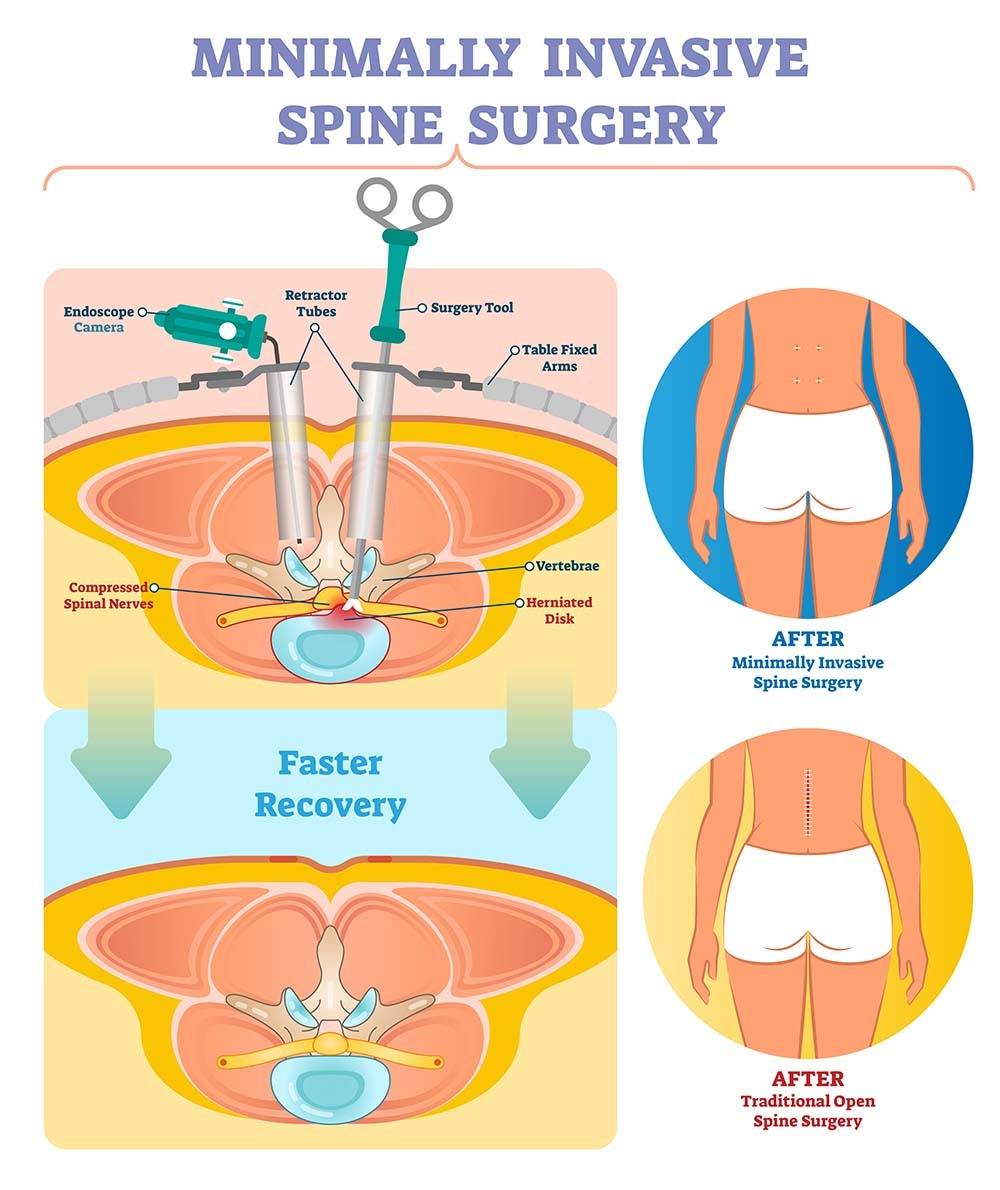 Minimally Invasive Spine Surgery in NJ